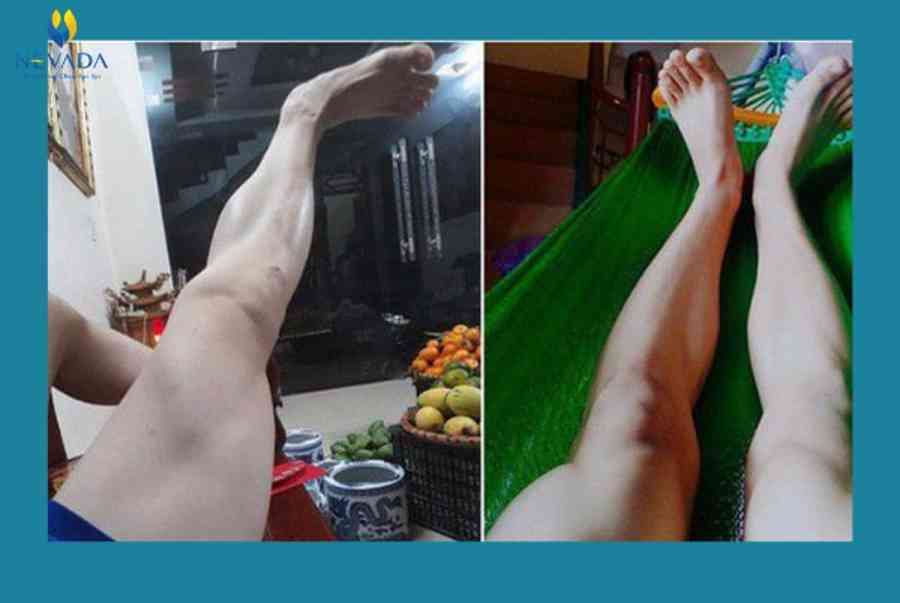 Tướng đàn ông ít lông chân nói lên điều gì? Đàn ông lông chân ít thì sao?