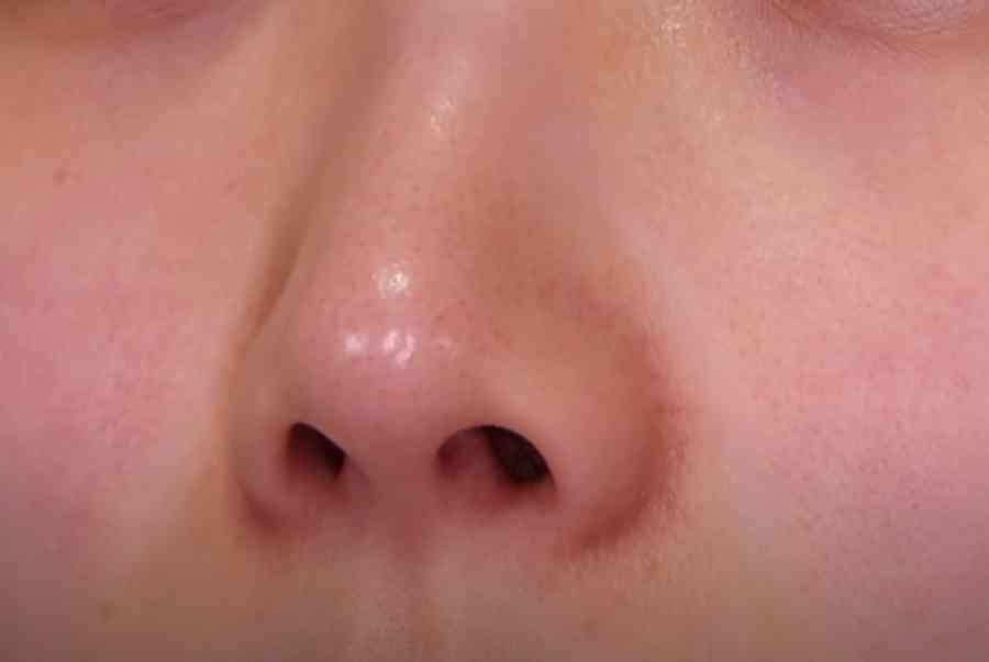 Bật mí cách trị mụn đầu đen bằng Vaseline và dầu tẩy trang