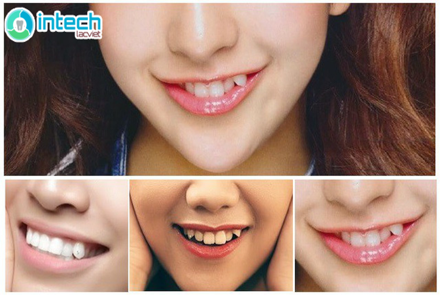 Đính đá vào răng khểnh giá bao nhiêu – Nha khoa Lạc Việt Intech